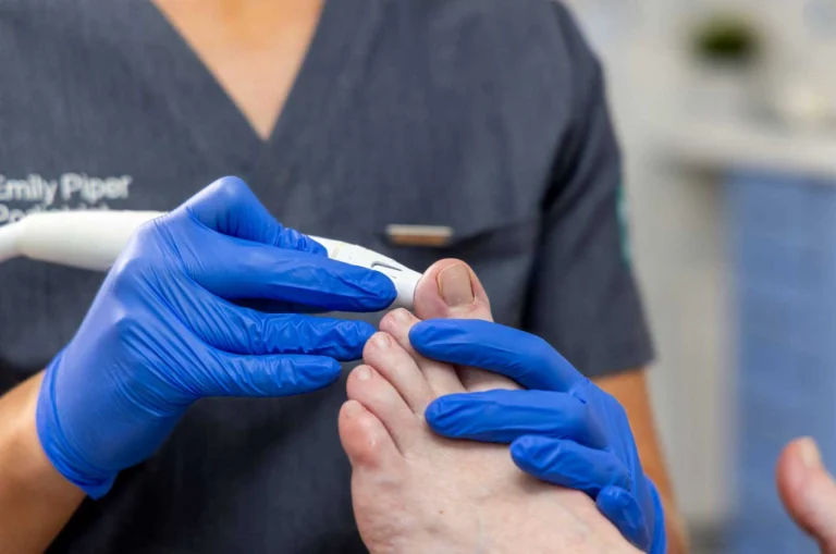 Verruca treatment Exeter